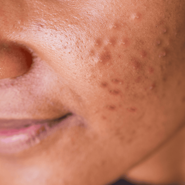 Adult Acne Explained: A Founder's Guide to Understanding and Treating Breakouts – Sachi Skin