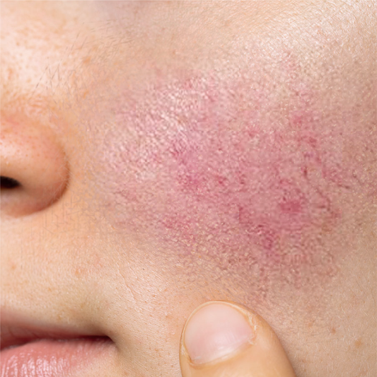 Calm and Soothe Reddened, Reactive and Sensitive Skin