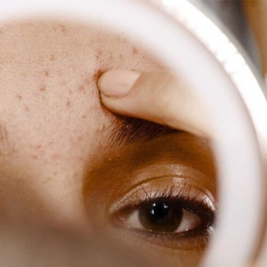 10 Tips That Actually Helped My Acne (And Might Help Yours Too)