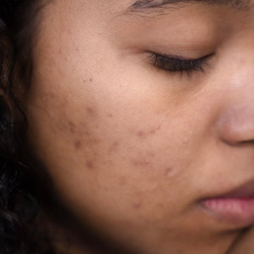 Breakouts this Summer? Here's How to Prevent Them