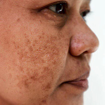 Keeping Melasma at Bay Over the Summer