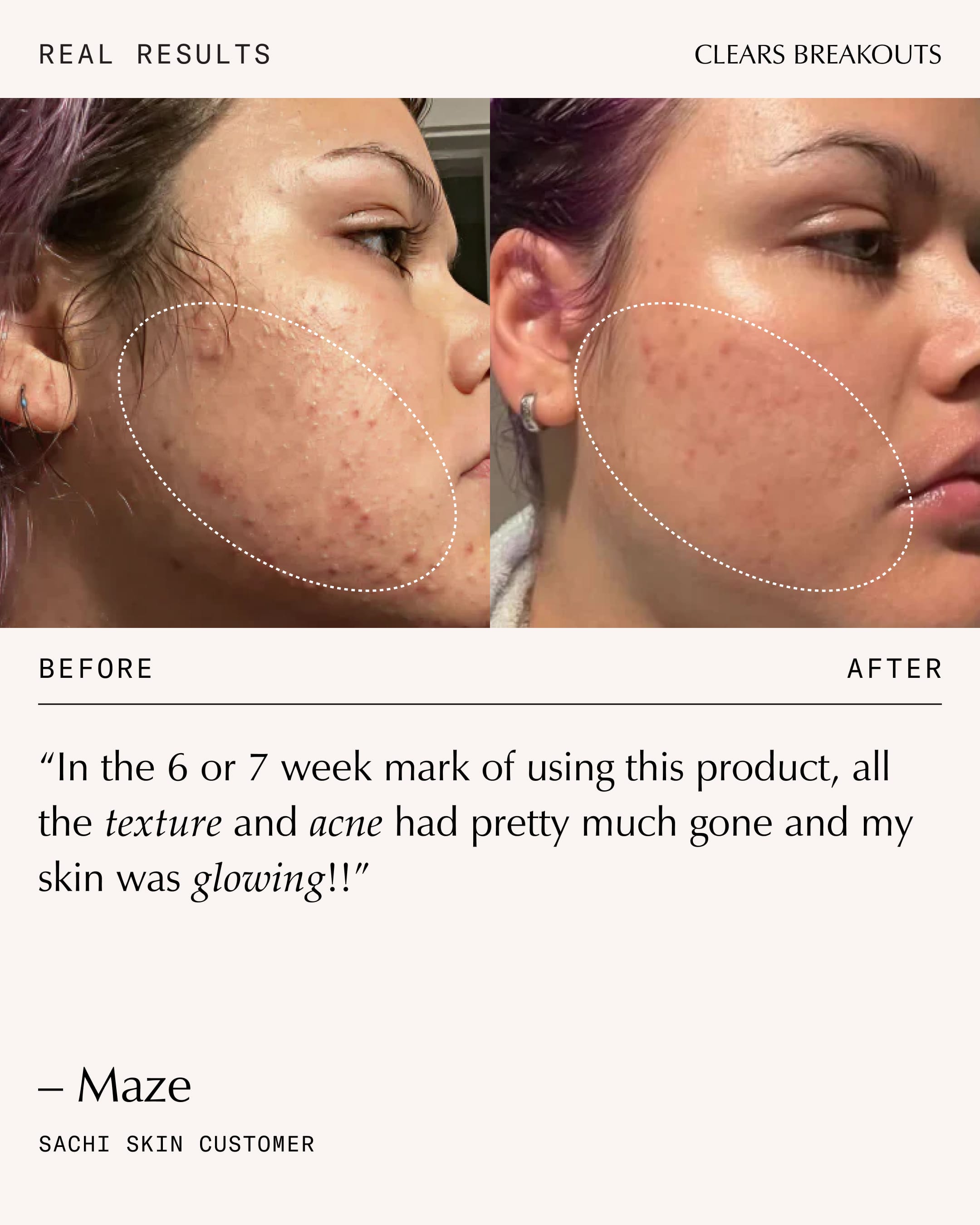 Complexion Clarifying Accelerator with Dioic Acid | Resurface