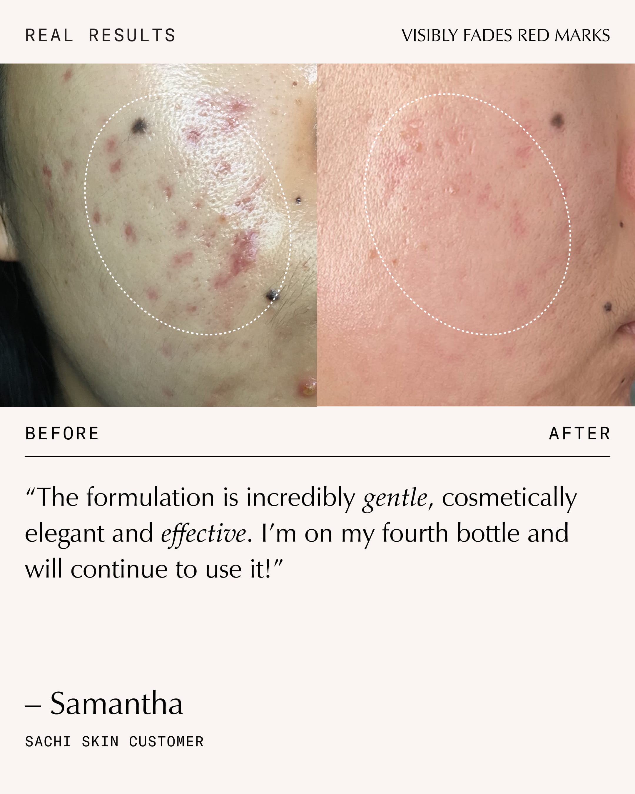 Triphala Pigmentation Corrector | Hyperpigmentation Serum – Sachi Skin